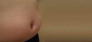 ¿Cuáles son las causas de la obesidad?