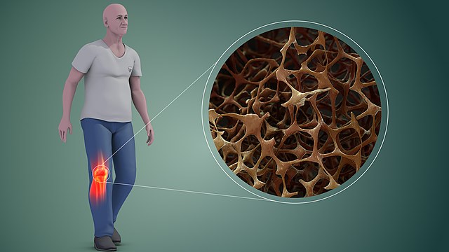 Factores-geneticos-y-constitucionales-osteoporosis