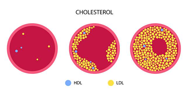 Colesterol-sangre-arteria-Retos