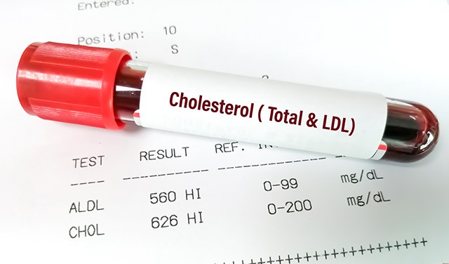 Muestra-de-sangre-con-colesterol-anormalmente-alto-Retos